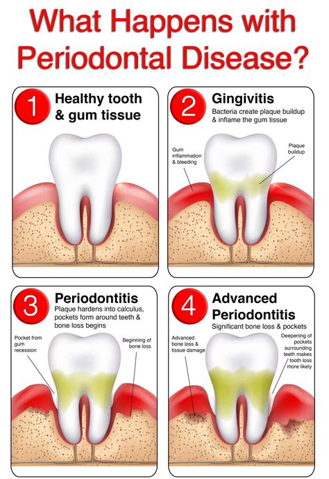 Gum Disease Early Signs