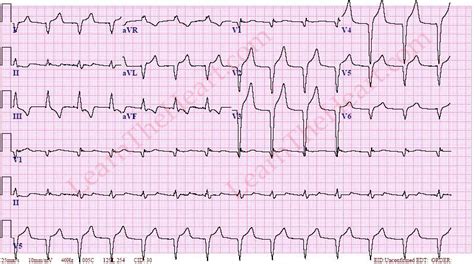 AIVR ECG | LearntheHeart.com