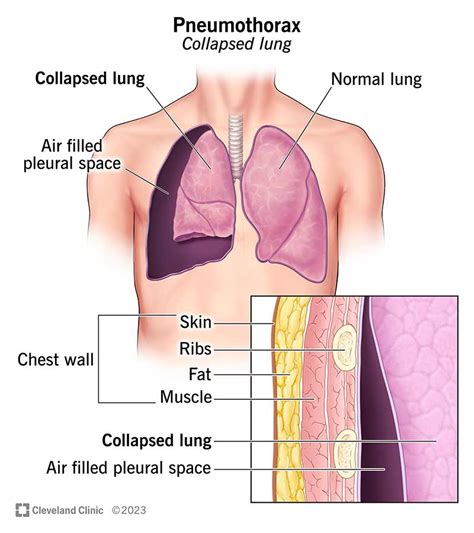 Pneumothorax (Collapsed Lung): Symptoms & Treatment