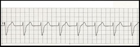 Basic EKG Rhythm Test 06