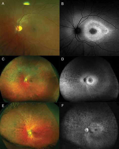 Visual hallucinations and sight loss in children and young adults: a ...