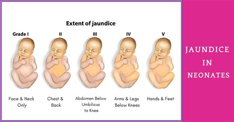 Why are newborns prone to jaundice? | Sri Ramakrishna Hospital