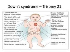 Trisomy 21 (aka Downs Syndrome)