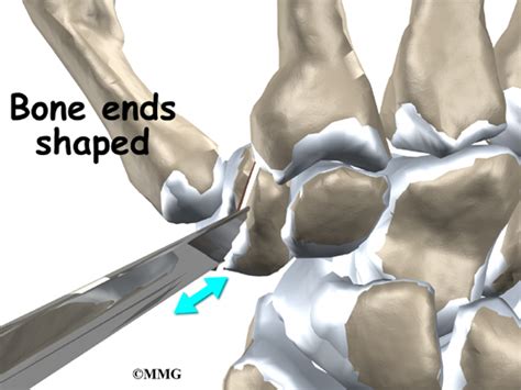 Artificial Joint Replacement of the Thumb - eOrthopod.com