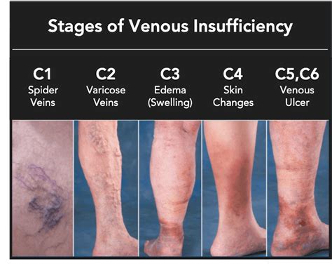 Pathophysiology Of Venous Insufficiency