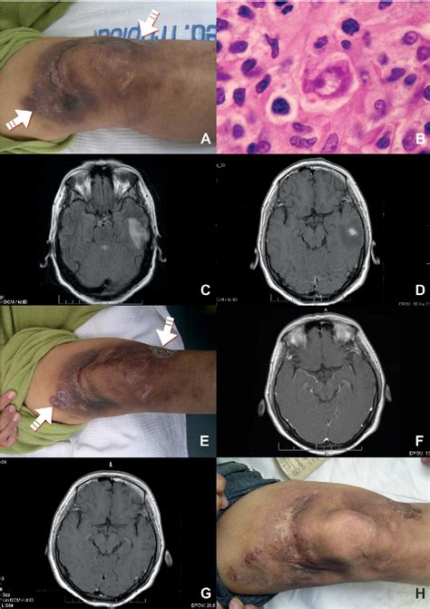 [PDF] Successful treatment of Balamuthia mandrillaris amoebic infection ...