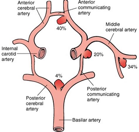 √ Aneurysm : Endovascular treatment of intracranial aneurysms - Because ...