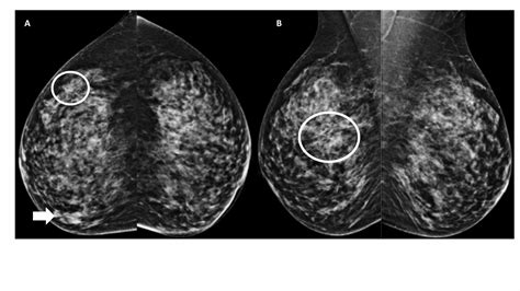 Mammography Projections