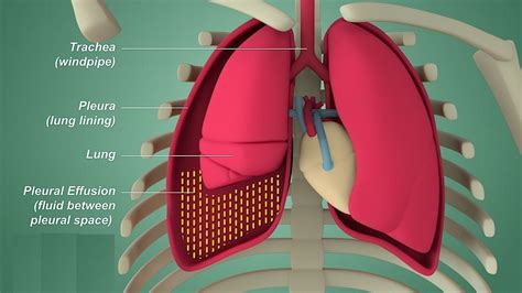 Pleural effusion: Etiology, Clinical Features, Diagnosis, and Treatment ...