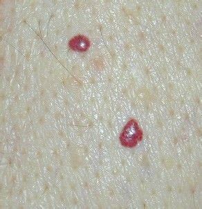 Why People Get Those Little Red Spots Called Cherry Angiomas