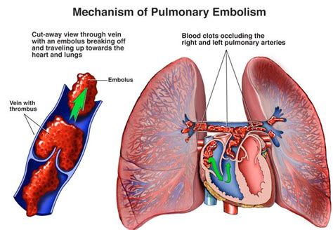 Pulmonary Embolism Treatment in New Jersey | Lung, Vascular Care