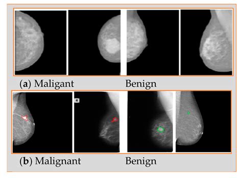 Applied Sciences | Free Full-Text | Breast Cancer Detection Using ...