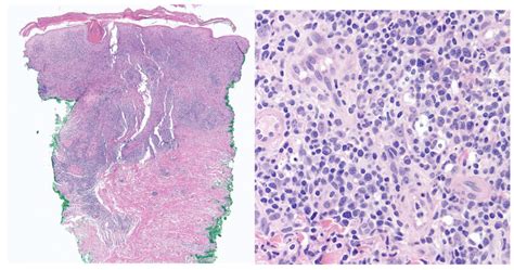 Histopathology of the skin biopsy showing lichenoid... | Download ...