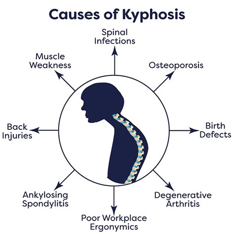 Kyphosis Treatment in NJ and NYC | Kyphosis Surgery in New Jersey