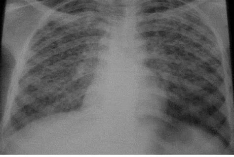 Miliary Tuberculosis (TB) Symptoms, Causes, Radiology, Diagnosis ...