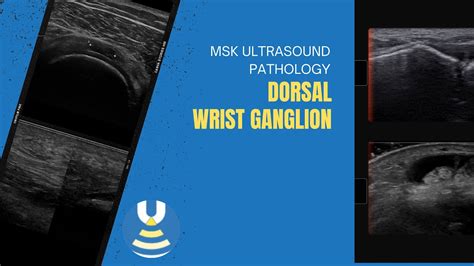 Dorsal wrist ganglion - YouTube