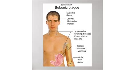 Main Symptoms of Black Death Bubonic Plague Chart Poster | Zazzle