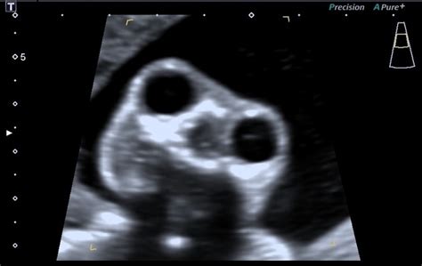 Anencephaly Ultrasound Findings