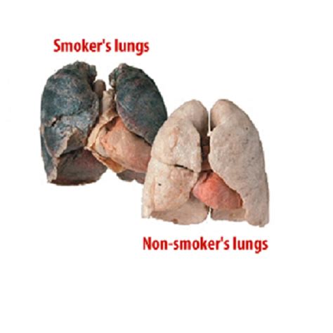 Smokers Lungs Vs Non Smokers Lungs