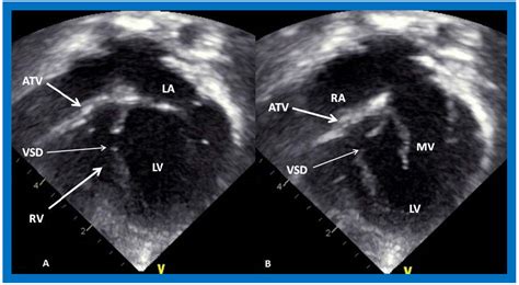 Applied Sciences | Free Full-Text | Echocardiography in the Diagnosis ...