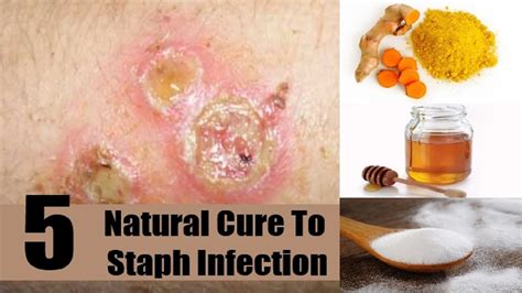 5 Home Remedies For Staph Infection on Face | By Top 5. - YouTube