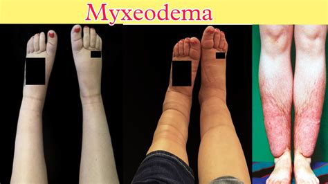 Myxedema: What is Myxeodema? Sign & symptoms, diagnosis: — GS India ...