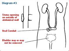 Stoma Illustrations