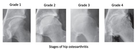 Orion - Hip Arthritis