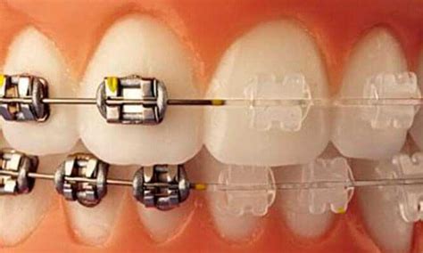 meditación masa ruptura aparatos dentales de ceramica Dureza lengua Varios