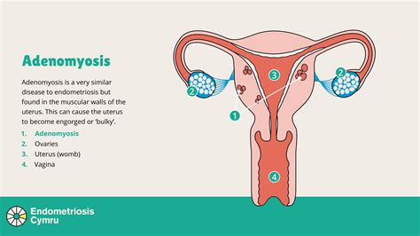 What is adenomyosis? - Endo Cymru