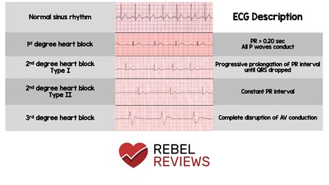 AV Heart Blocks - REBEL EM - Emergency Medicine Blog