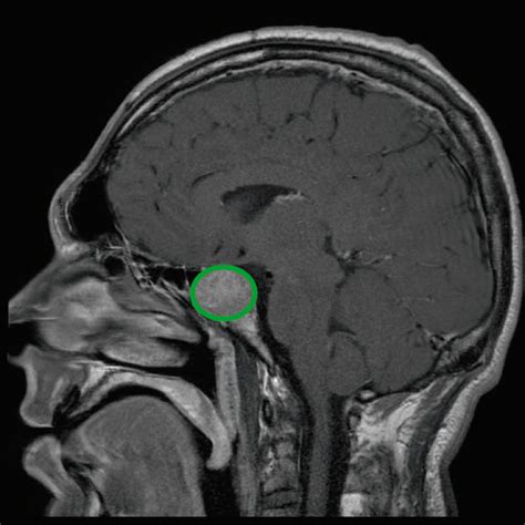 Pituitary Mri Labeled