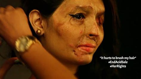 19-Year-Old Acid Burn Victim to Walk Runway at New York Fashion Week ...