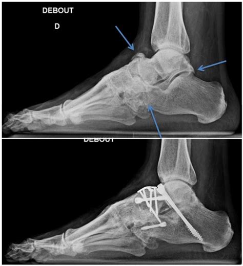 Arthrodesis – Foot and Ankle Institute