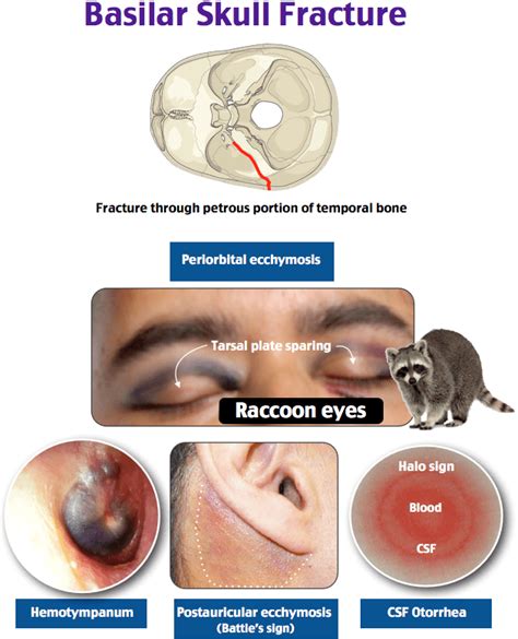 Today's Essential Teaching Image: Basilar Skull Fracture - RoshReview.com