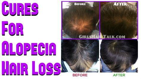 Cures For Alopecia To Get Hair Regrowth Results Fast!