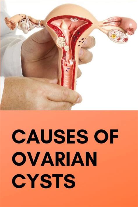 Causes of Ovarian Cysts - Health Experts | Ovarian cyst, Ovarian, Cysts