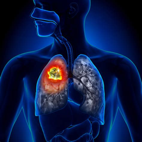 Stereotactic Body Radiation Therapy Improves NSCLC Patient Survival