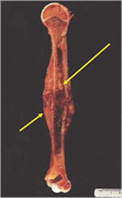 Ewing Sarcoma : Bone Tumor Cancer : Tumors of the Bone