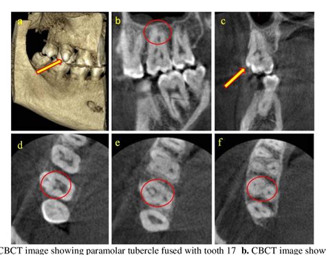 Figure 1 from Endodontic Management of a Rare Anamoly of Paramolar ...