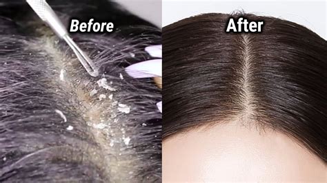 How To Treat Dandruff How To Treat Dandruff At Home And My Hair Oiling ...