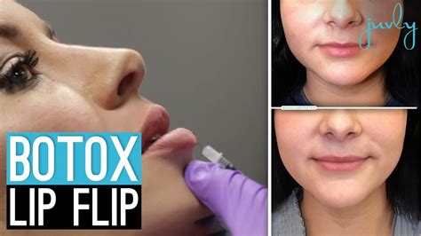 Botox Lip Flip Before And After