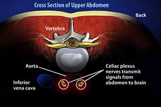 Celiac Plexus Block Technique