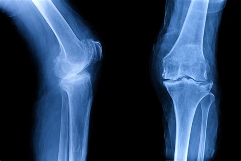 Treating knee osteoarthritis without surgery - Northwestern Now