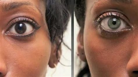 Eye implants that change your iris color. | Eye color change surgery ...