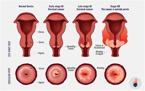 Smear Tests - The Complete Guide | Elara Care