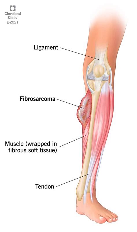 Fibrosarcoma: Symptoms, Causes & Treatment