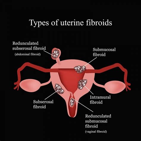 Uterusmyome und ihre Bedeutung für die Fruchtbarkeit - Babywunsch.com