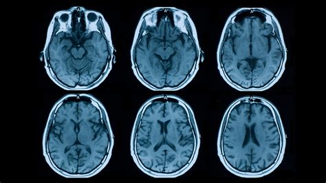 HOW DOES MRI HELP DIAGNOSE MS? - Mayfair Diagnostics