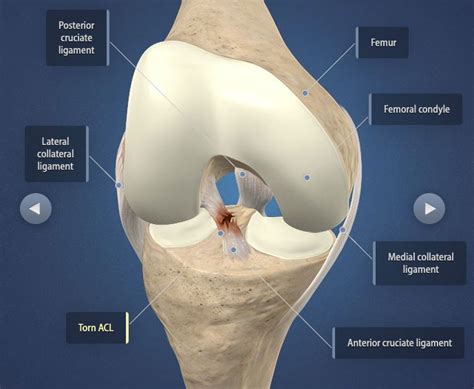 The Do's and Don'ts After ACL & MCL Tears & Surgery | Heiden Orthopedics